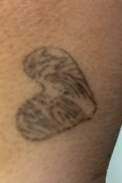 Caso 1 de remoção de tatuagem com o Neo One: antes