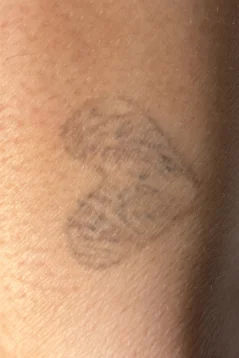Caso 1 de remoção de tatuagem com o Neo One: depois
