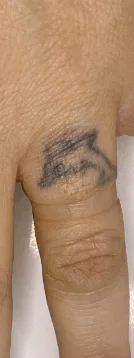 Caso 2 de remoção de tatuagem com o Neo One: antes