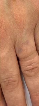 Caso 2 de remoção de tatuagem com o Neo One: depois