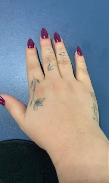 Caso 3 de remoção de tatuagem com o Neo One: antes