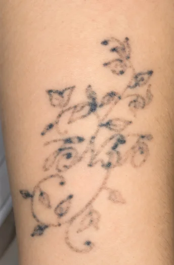 Remoção de tatuagem floral com o Infinity Duos: após 2 sessões